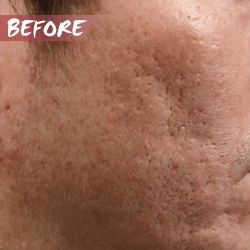 fractional microneedle rf Large Pores before Large Pores before