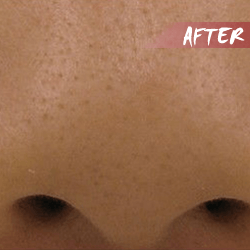 fractional microneedle rf enlarged pore after