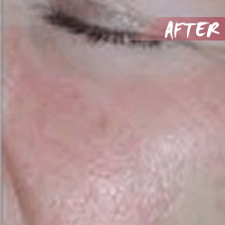 fractional microneedle rf rskin lift after