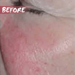 fractional microneedle rf skin lift before