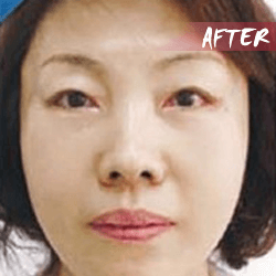 fractional microneedle rf skin lifting after