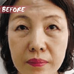 fractional microneedle rf skin lifting before