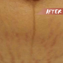 fractional microneedle rf stretch marks after