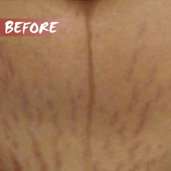fractional microneedle rf stretch marks before
