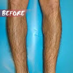 types of laser hair removal machines