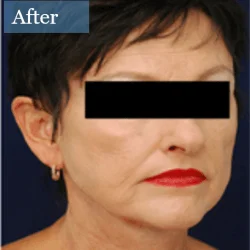 HIFU face lifting machine