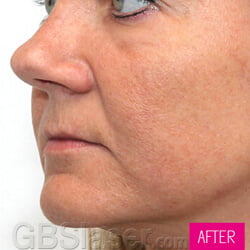 Jet Peel skin Rejuvenation