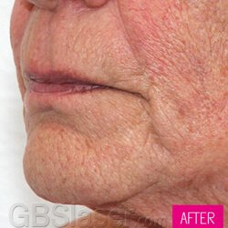 Jet Peel facial wrinkle