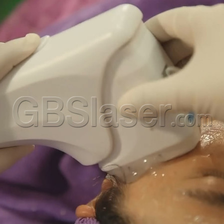 HIFU face lift skin tightening, hifu face lift