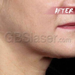 ultrasound machine neck lift After