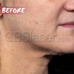 ultrasound machine neck lift Before