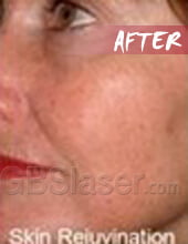 LED light skin rejuvenation after LED light skin rejuvenation after