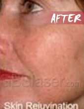 LED light skin rejuvenation after