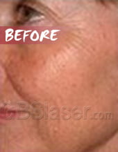 LED light skin rejuvenation before