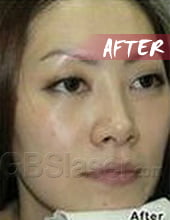 LED pigmentation removal after