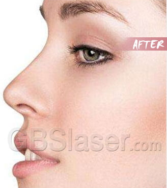 home use rf skin rejuvenationTreatment Before and after