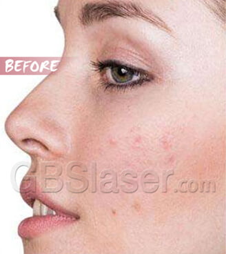 home use rf skin rejuvenationTreatment Before