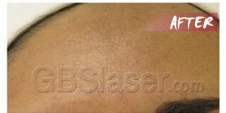 aqua dermabrasion pigmentation treatment after