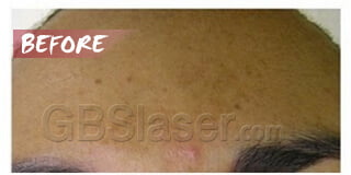 aqua dermabrasion pigmentation treatment before