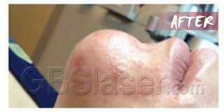 dermabrasion in improvement acne after