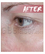 eye wrinkles after