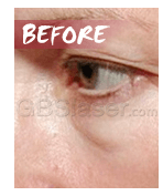 eye wrinkles before