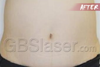 liposuction abdomen treatment after