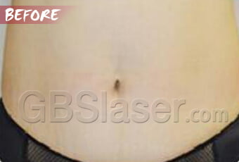 liposuction abdomen treatment before