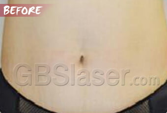 liposuction abdomen treatment before liposuction abdomen treatment before