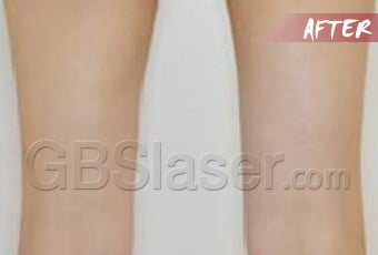 liposuction thighs treatment after
