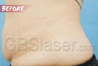 liposuction waist treatment before