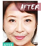 mesotherapy Injector after