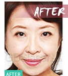 mesotherapy Injector after mesotherapy Injector after