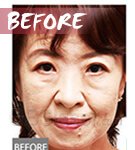mesotherapy Injector before mesotherapy Injector before
