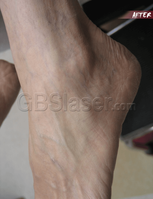 spider vein removal 1 after spider vein removal