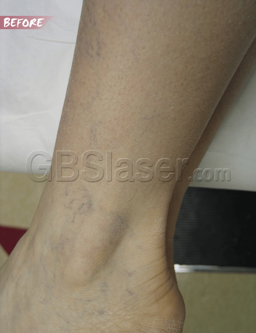 spider vein removal