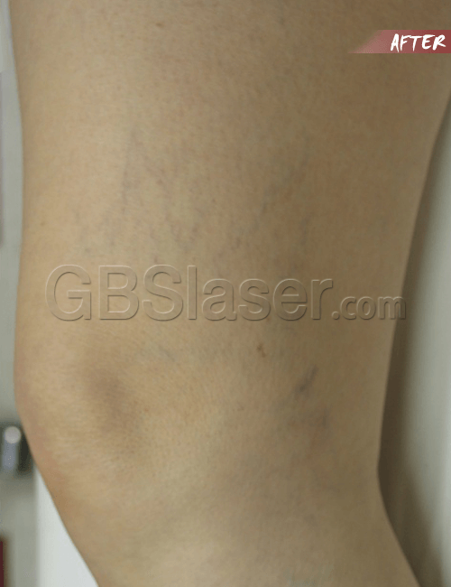 spider vein removal