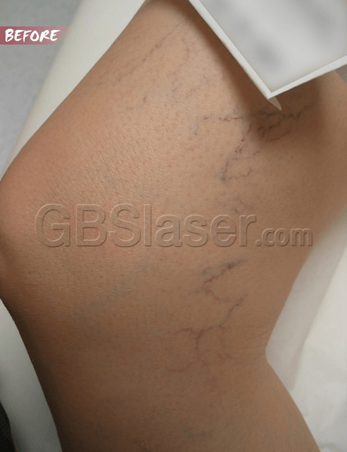 spider vein removal