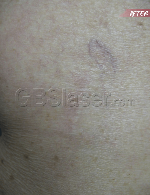 spider vein removal 3 after spider vein removal