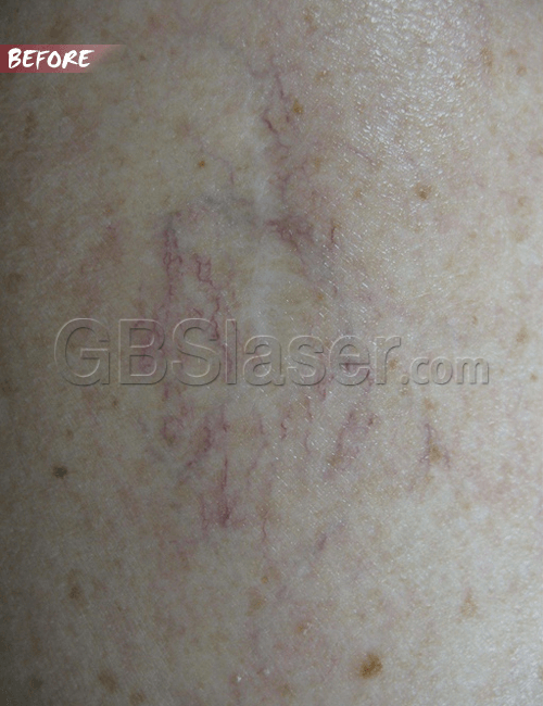 spider vein removal 3 before spider vein removal
